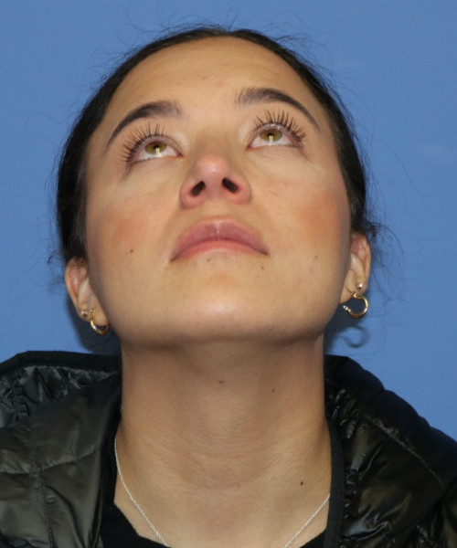 Rhinoplasty #6287 – click HERE for more views after photo. Individual results may vary.
