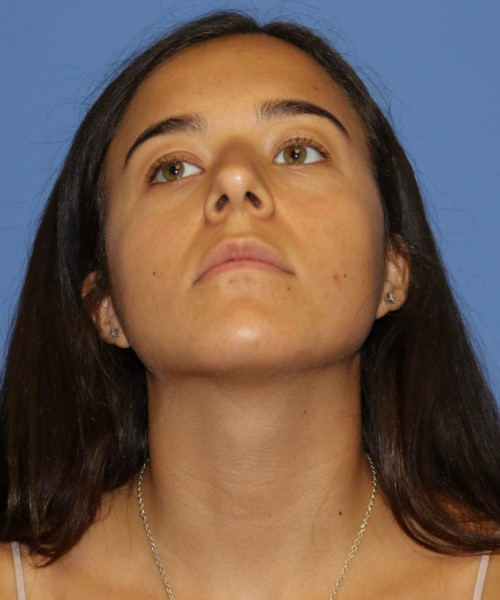 Rhinoplasty #6287 – click HERE for more views before photo. Individual results may vary.
