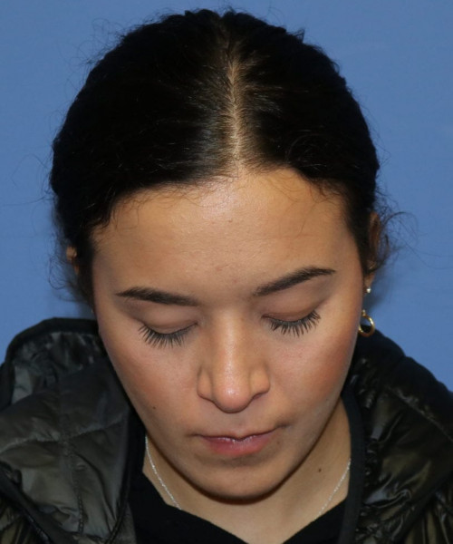 Rhinoplasty #6287 – click HERE for more views after photo. Individual results may vary.