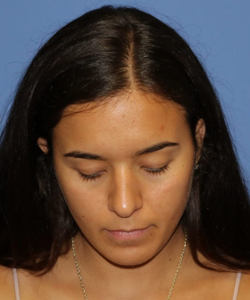 Rhinoplasty #6287 – click HERE for more views before photo. Individual results may vary.
