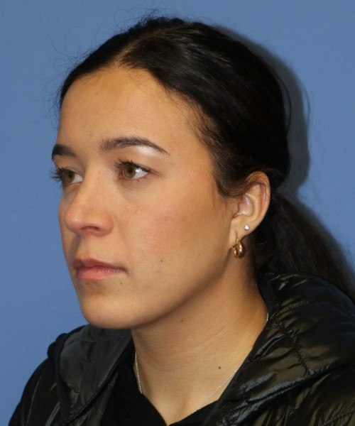 Rhinoplasty #6287 – click HERE for more views after photo. Individual results may vary.