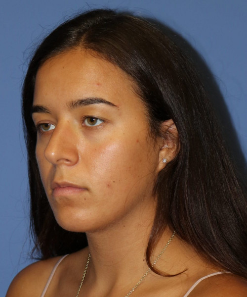Rhinoplasty #6287 – click HERE for more views before photo. Individual results may vary.