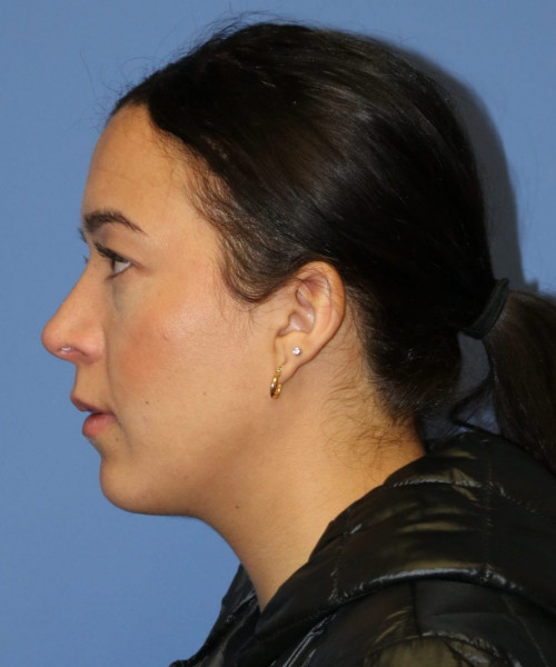 Rhinoplasty #6287 – click HERE for more views after photo. Individual results may vary.