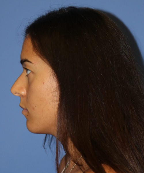Rhinoplasty #6287 – click HERE for more views before photo. Individual results may vary.