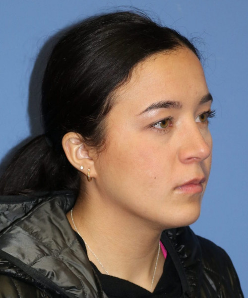 Rhinoplasty #6287 – click HERE for more views after photo. Individual results may vary.
