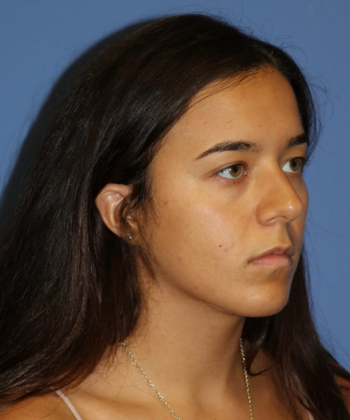 Rhinoplasty #6287 – click HERE for more views before photo. Individual results may vary.