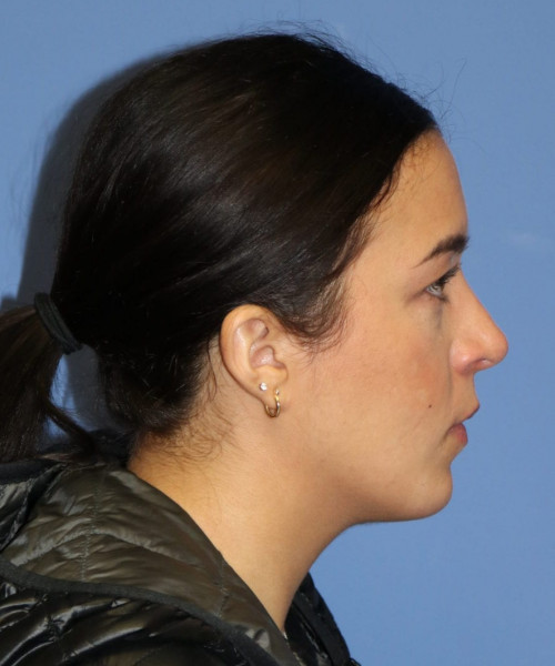 Rhinoplasty #6287 – click HERE for more views after photo. Individual results may vary.