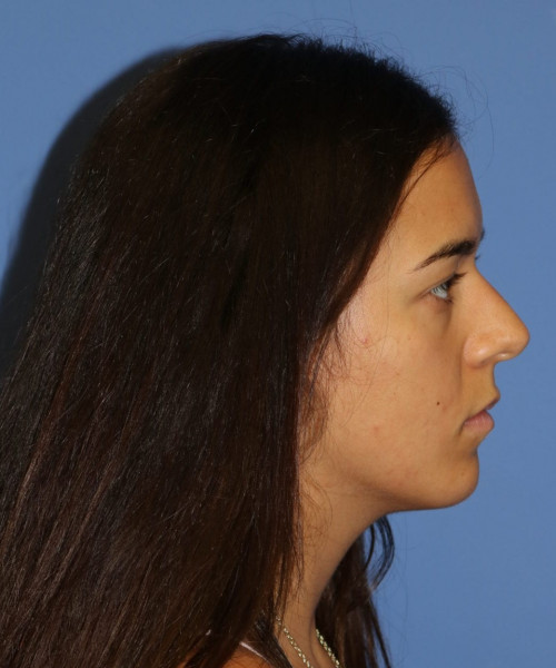 Rhinoplasty #6287 – click HERE for more views before photo. Individual results may vary.