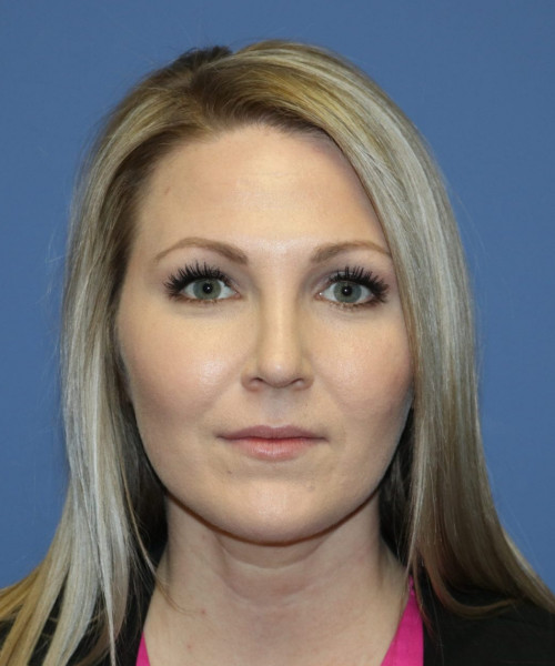 Rhinoplasty #6332 – click HERE for more views after photo. Individual results may vary.