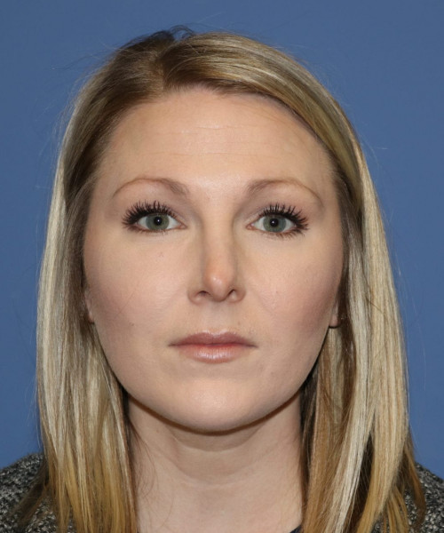 Rhinoplasty #6332 – click HERE for more views before photo. Individual results may vary.