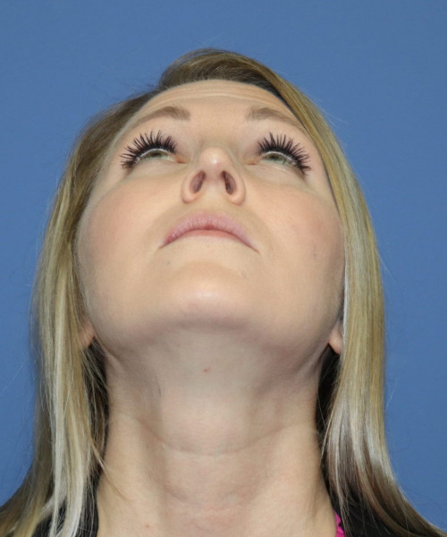 Rhinoplasty #6332 – click HERE for more views after photo. Individual results may vary.