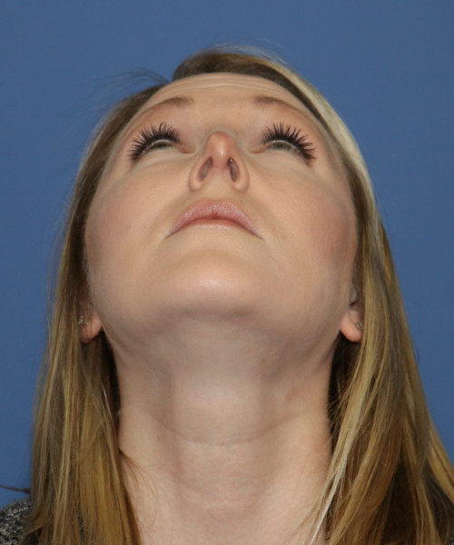 Rhinoplasty #6332 – click HERE for more views before photo. Individual results may vary.