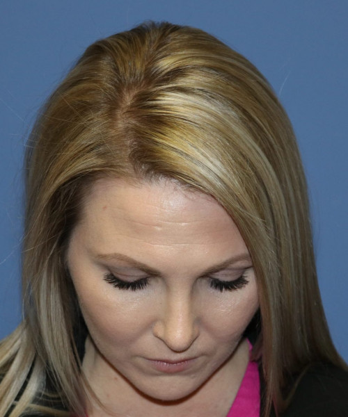 Rhinoplasty #6332 – click HERE for more views after photo. Individual results may vary.