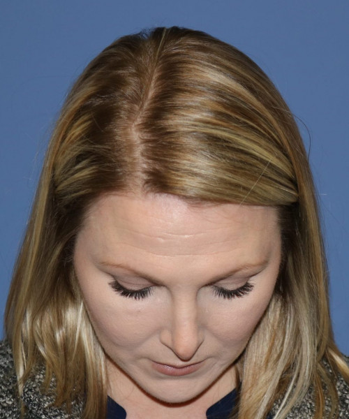 Rhinoplasty #6332 – click HERE for more views before photo. Individual results may vary.