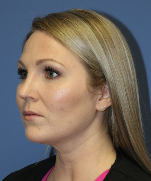 Rhinoplasty #6332 – click HERE for more views after photo. Individual results may vary.