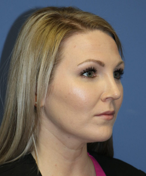 Rhinoplasty #6332 – click HERE for more views after photo. Individual results may vary.