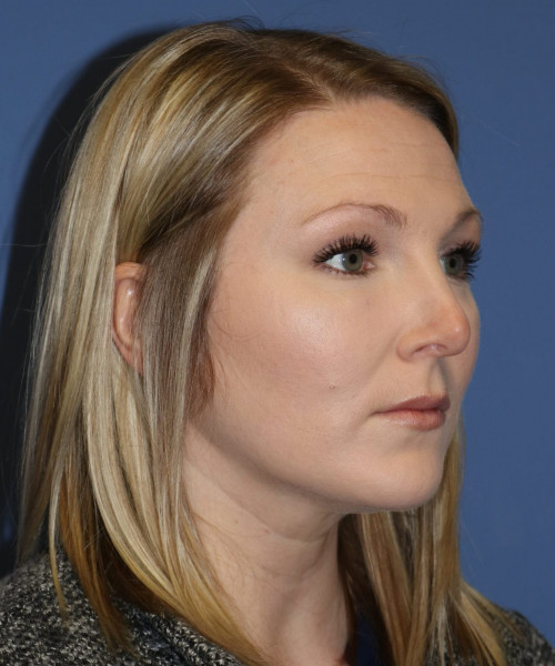 Rhinoplasty #6332 – click HERE for more views before photo. Individual results may vary.