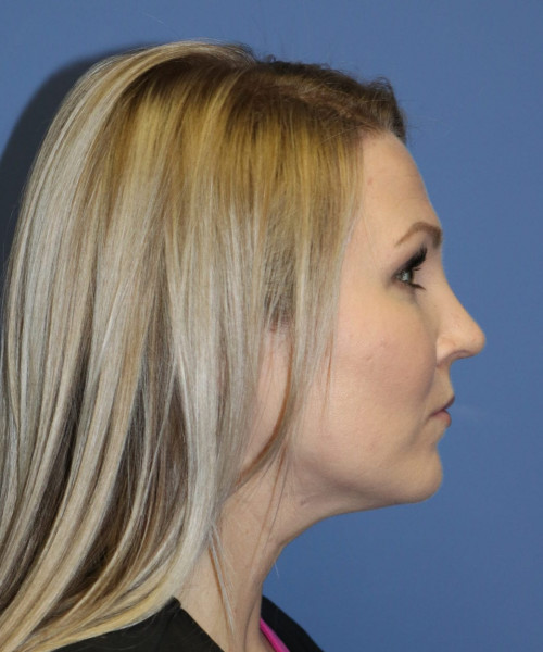 Rhinoplasty #6332 – click HERE for more views after photo. Individual results may vary.