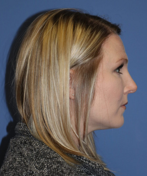 Rhinoplasty #6332 – click HERE for more views before photo. Individual results may vary.