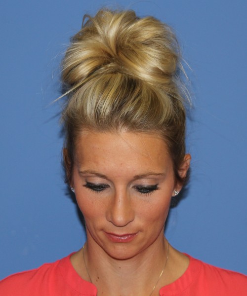 Rhinoplasty 0634 – Click HERE for more views after photo. Individual results may vary.