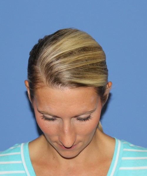 Rhinoplasty 0634 – Click HERE for more views before photo. Individual results may vary.