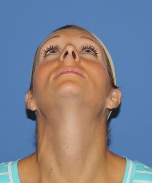 Rhinoplasty 0634 – Click HERE for more views before photo. Individual results may vary.