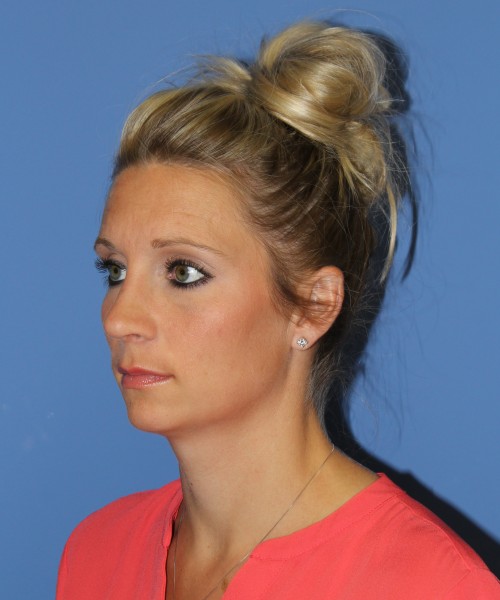 Rhinoplasty 0634 – Click HERE for more views after photo. Individual results may vary.