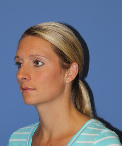 Rhinoplasty 0634 – Click HERE for more views before photo. Individual results may vary.