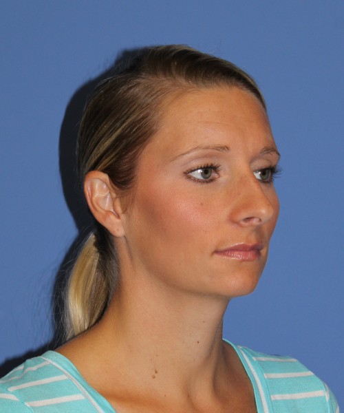 Rhinoplasty 0634 – Click HERE for more views before photo. Individual results may vary.