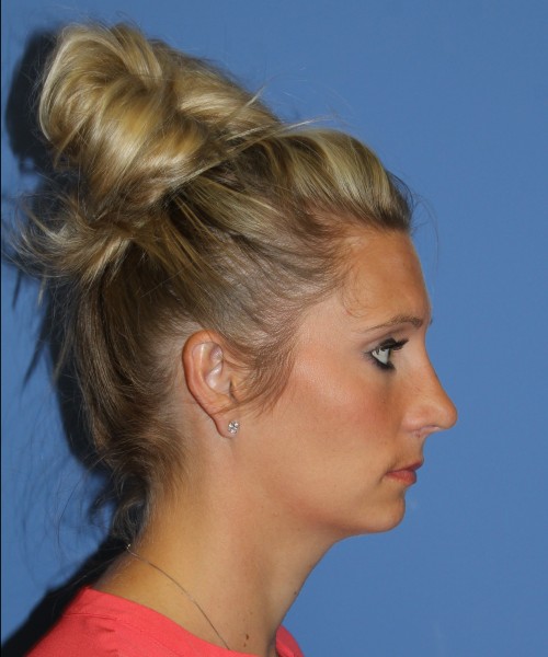 Rhinoplasty 0634 – Click HERE for more views after photo. Individual results may vary.