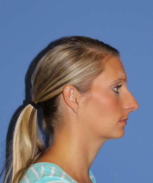 Rhinoplasty 0634 – Click HERE for more views before photo. Individual results may vary.