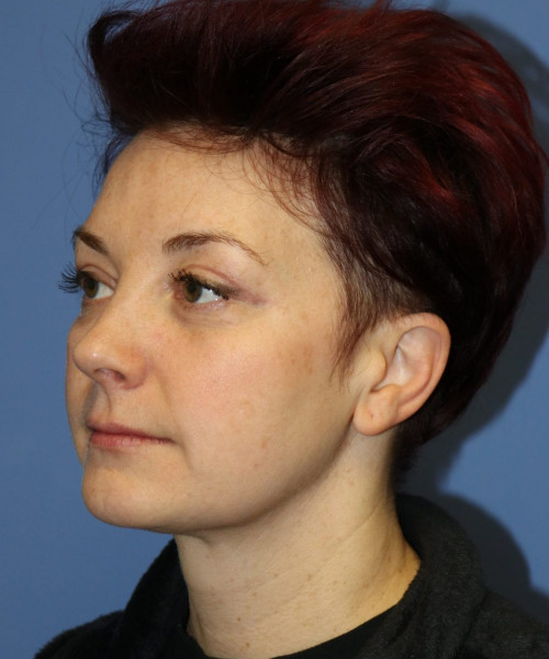 Blepharoplasty #6349 – click HERE for more views after photo. Individual results may vary.