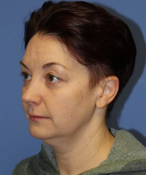 Blepharoplasty #6349 – click HERE for more views before photo. Individual results may vary.