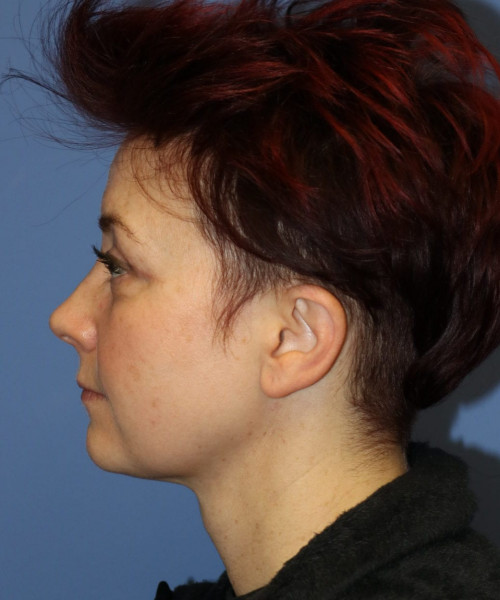 Blepharoplasty #6349 – click HERE for more views after photo. Individual results may vary.