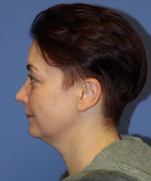 Blepharoplasty #6349 – click HERE for more views before photo. Individual results may vary.