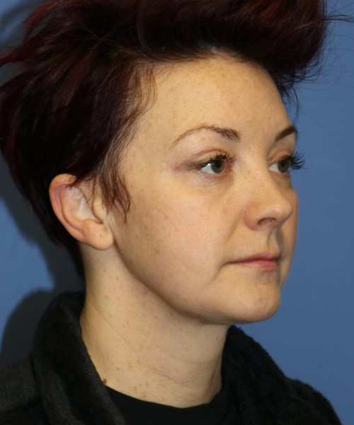 Blepharoplasty #6349 – click HERE for more views after photo. Individual results may vary.