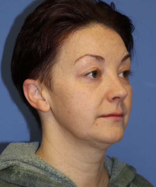 Blepharoplasty #6349 – click HERE for more views before photo. Individual results may vary.