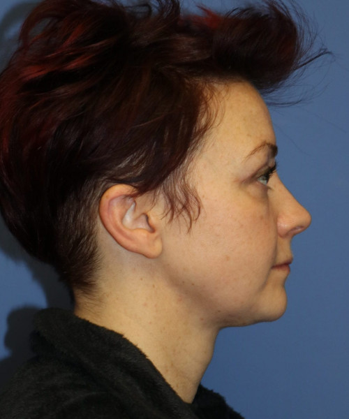 Blepharoplasty #6349 – click HERE for more views after photo. Individual results may vary.