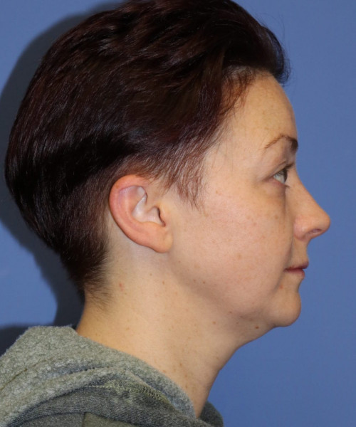Blepharoplasty #6349 – click HERE for more views before photo. Individual results may vary.