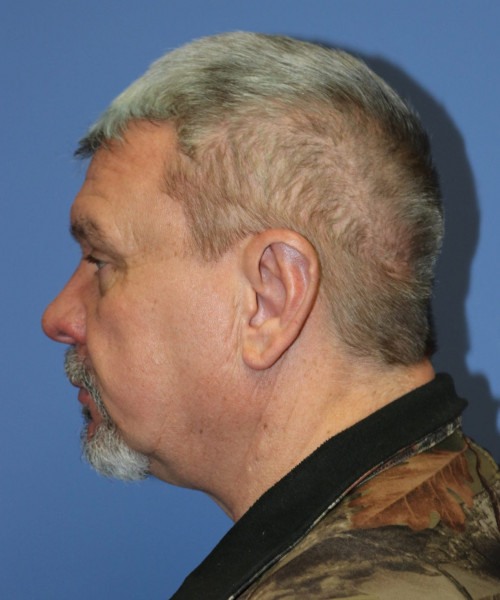 Otoplasty #6362 – click HERE for more views after photo. Individual results may vary.