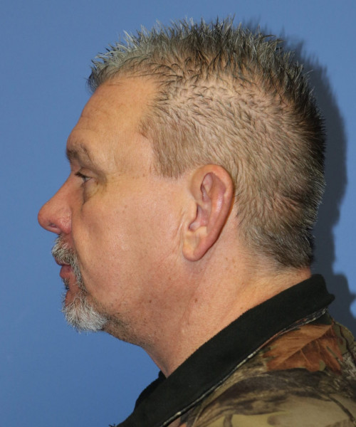 Otoplasty #6362 – click HERE for more views before photo. Individual results may vary.