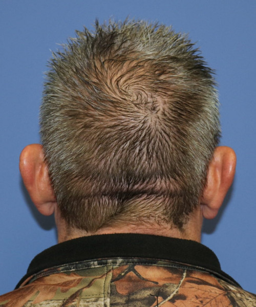 Otoplasty #6362 – click HERE for more views before photo. Individual results may vary.