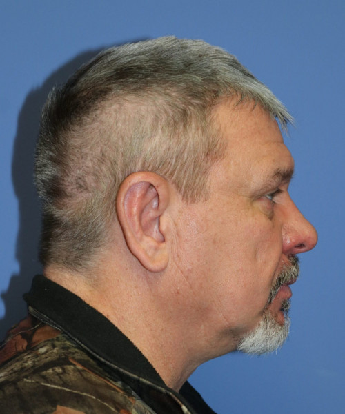 Otoplasty #6362 – click HERE for more views after photo. Individual results may vary.