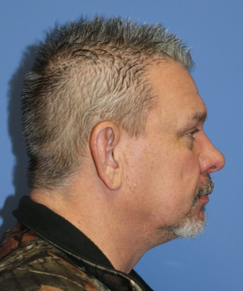 Otoplasty #6362 – click HERE for more views before photo. Individual results may vary.