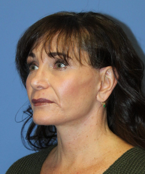 Facelift #6410 – click HERE for more views after photo. Individual results may vary.
