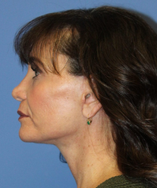 Facelift #6410 – click HERE for more views after photo. Individual results may vary.