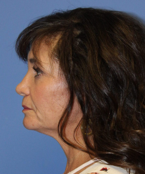 Facelift #6410 – click HERE for more views before photo. Individual results may vary.