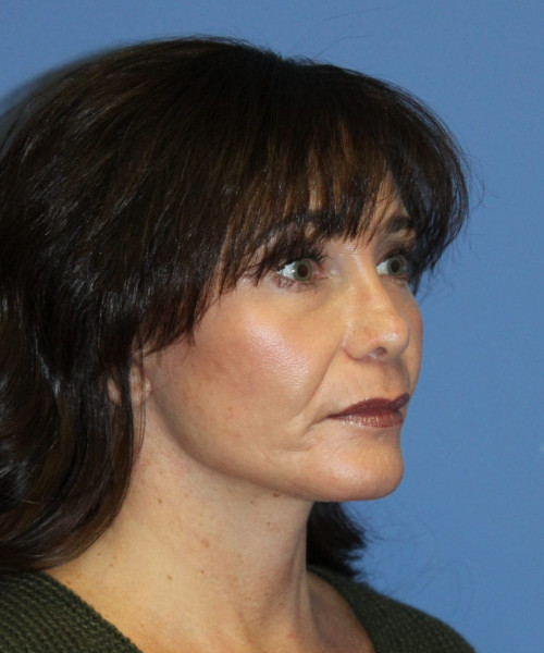 Facelift #6410 – click HERE for more views after photo. Individual results may vary.