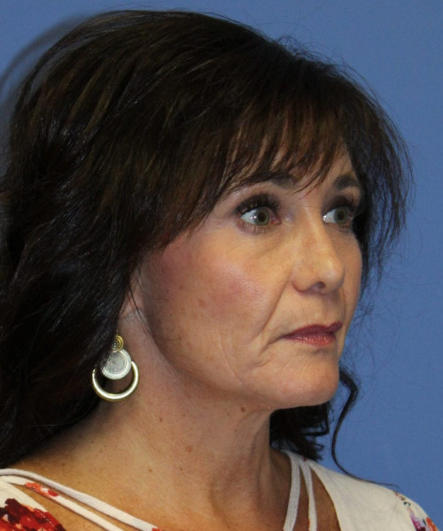 Facelift #6410 – click HERE for more views before photo. Individual results may vary.