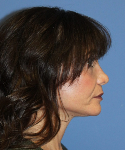 Facelift #6410 – click HERE for more views after photo. Individual results may vary.